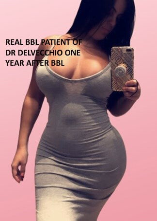 BBL PATIENT ONE YEAR POSTOP